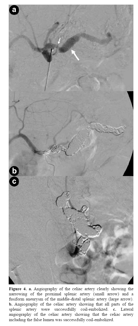 pancreas-angiography-celiac-artery