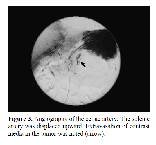 pancreas-angiography-celiac-artery