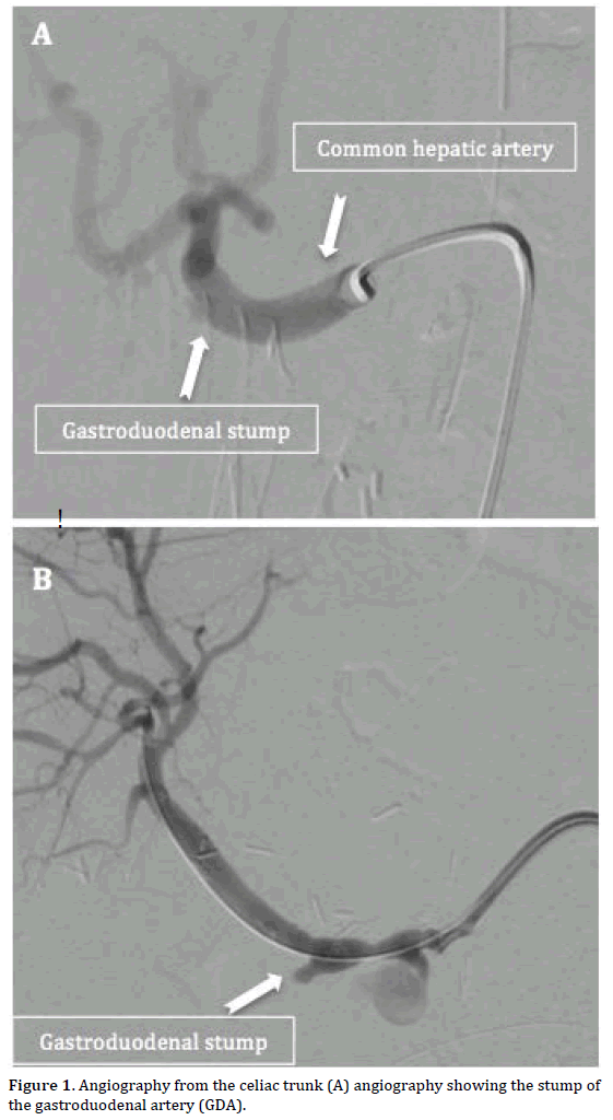 pancreas-angiography-celiac-trunk