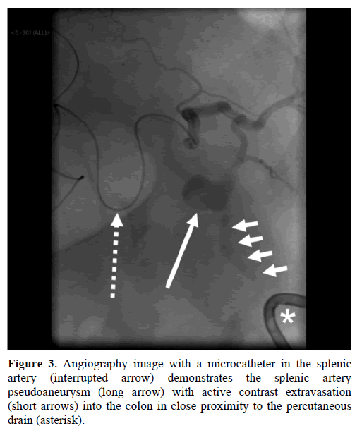 pancreas-angiography-microcatheter