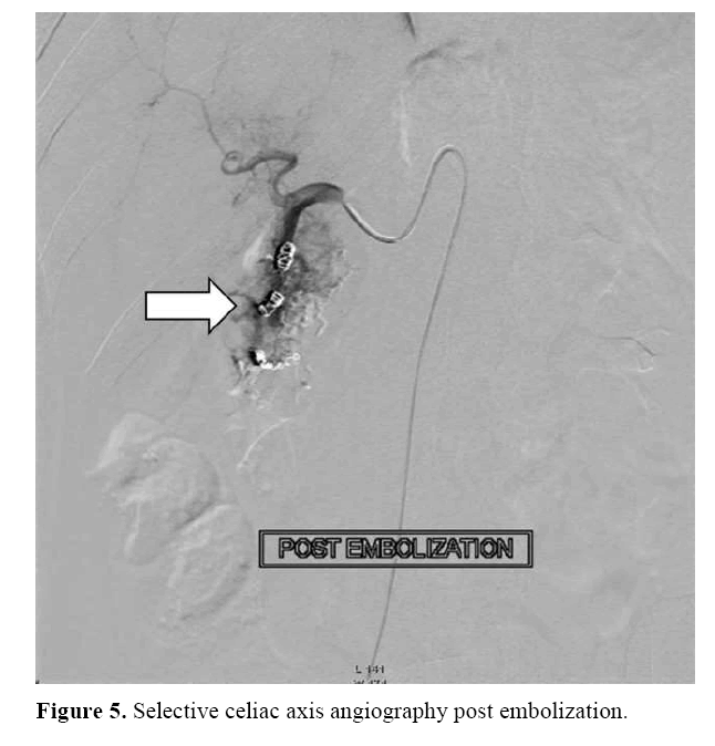 pancreas-angiography-post-embolization