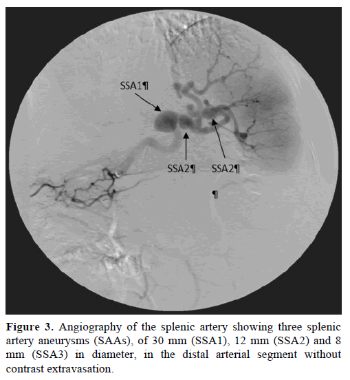 pancreas-angiography-splenic-artery