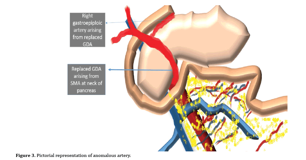 pancreas-anomalous-artery