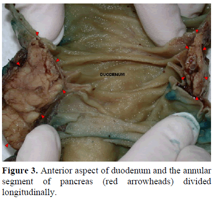 pancreas-anterior-aspect-duodenum