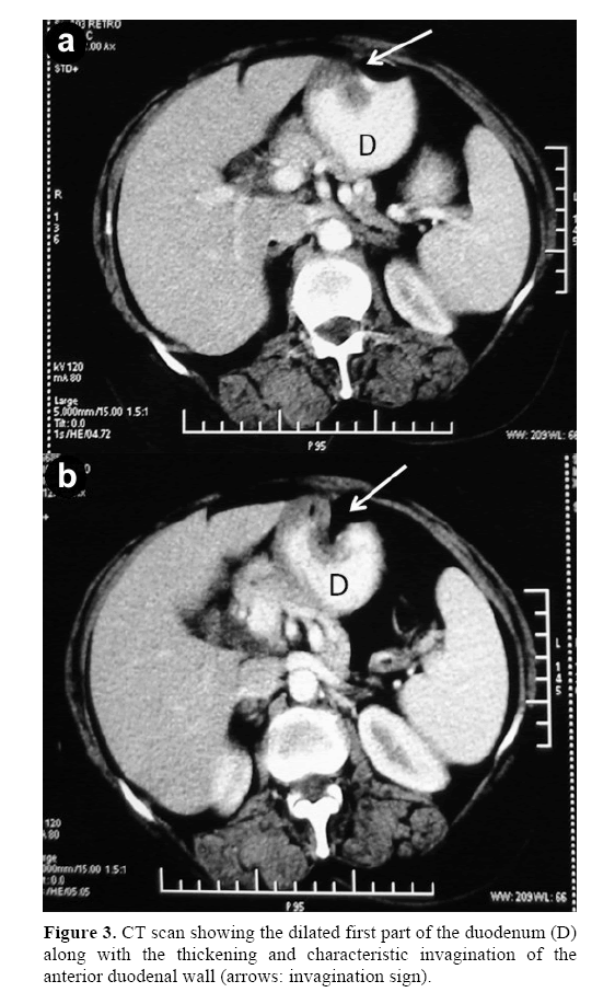 pancreas-anterior-duodenal-wall