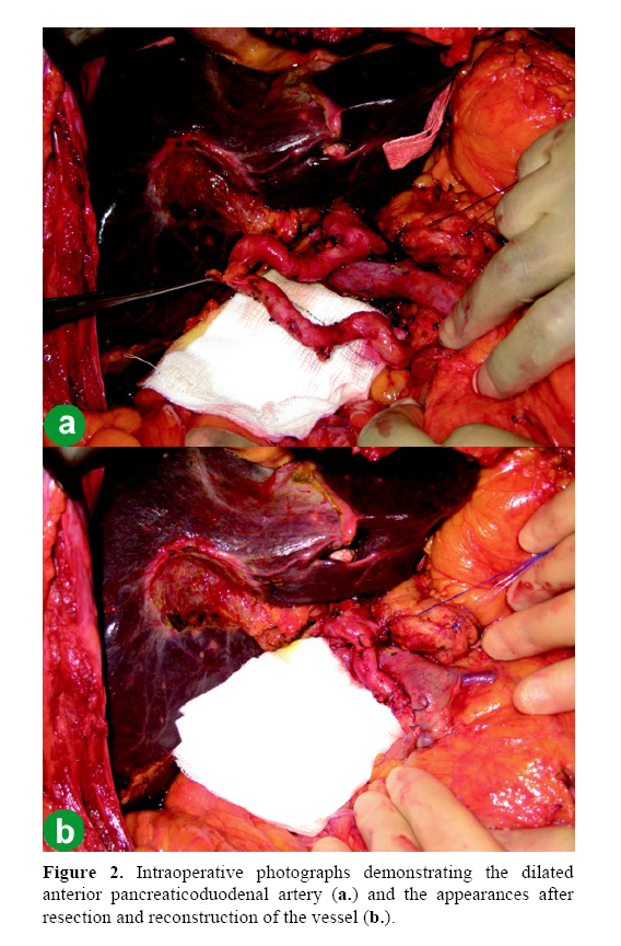 pancreas-anterior-pancreaticoduodenal