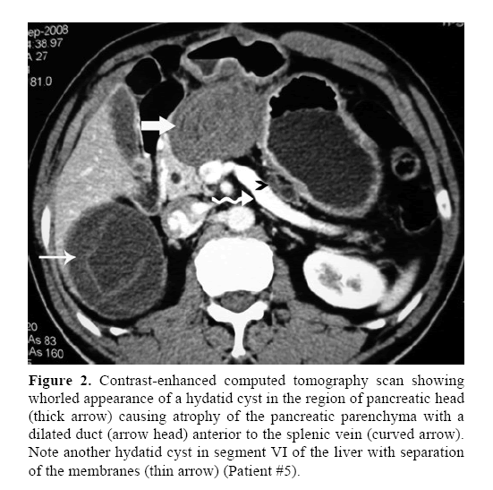 pancreas-anterior-splenic-vein