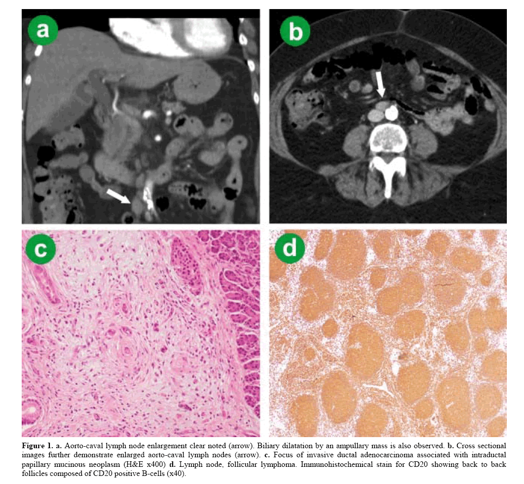 pancreas-aorto-caval-lymph-node