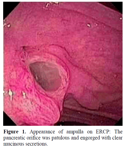 pancreas-appearance-ampulla-ercp