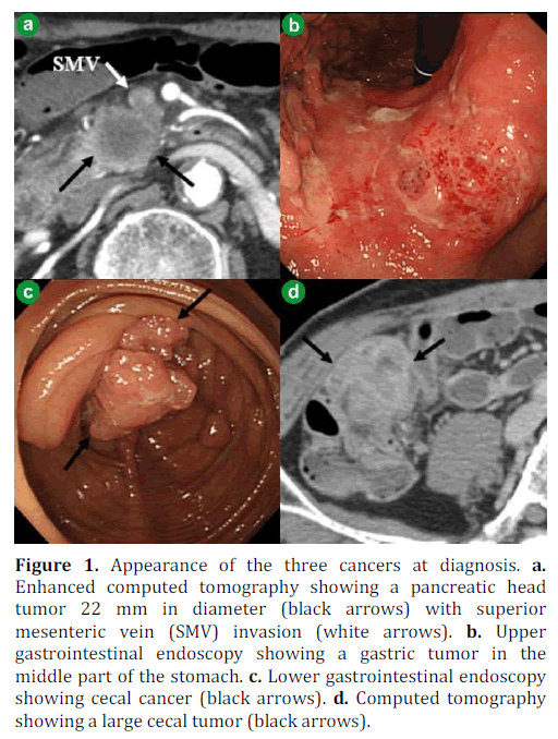 pancreas-appearance-three-cancers