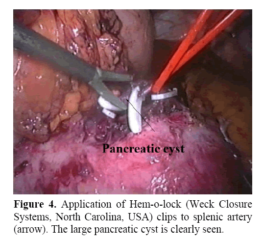 pancreas-application-Hem-o-lock