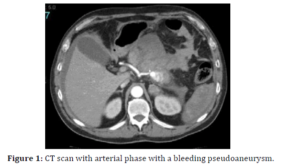 pancreas-arterial-bleeding-pseudoaneurysm