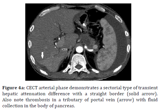 pancreas-arterial-hepatic-attenuation