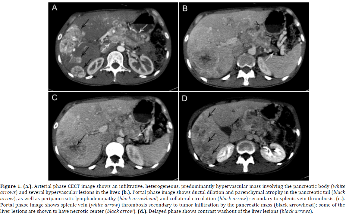 pancreas-arterial-phase-cect-image