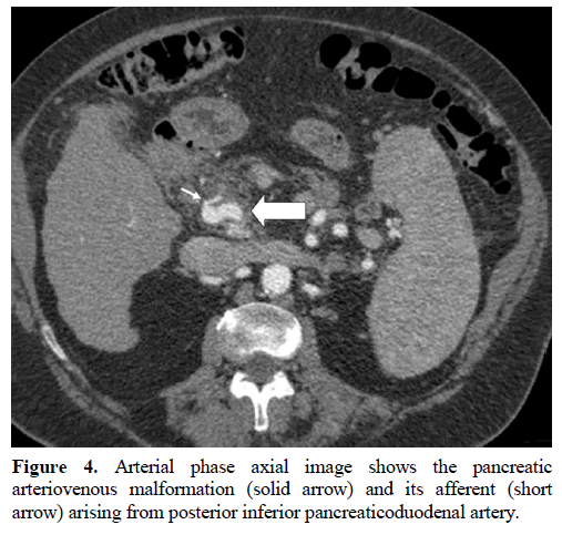 pancreas-arteriovenous-malformation-artery