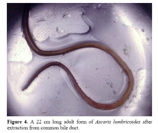 pancreas-ascaris-lumbricoides