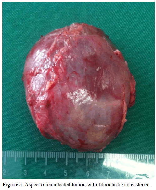 pancreas-aspect-enucleated-tumor