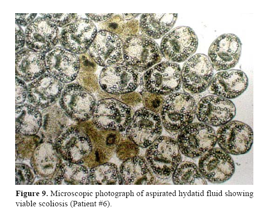 pancreas-aspirated-hydatid-fluid