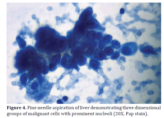 pancreas-aspiration