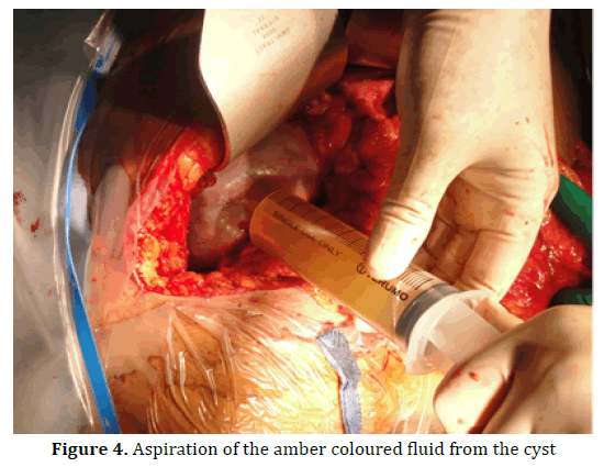 pancreas-aspiration-amber-coloured