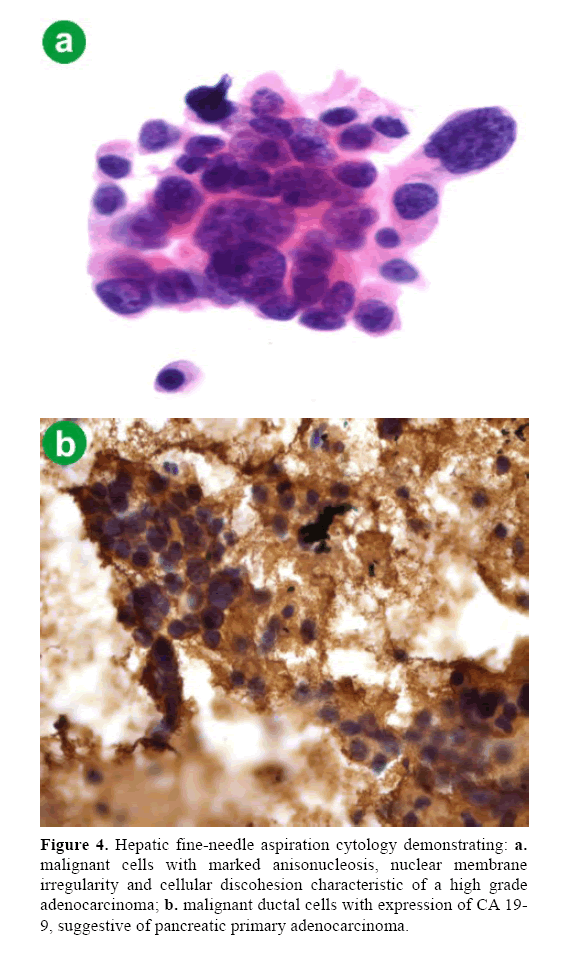 pancreas-aspiration-cytology-demonstrating