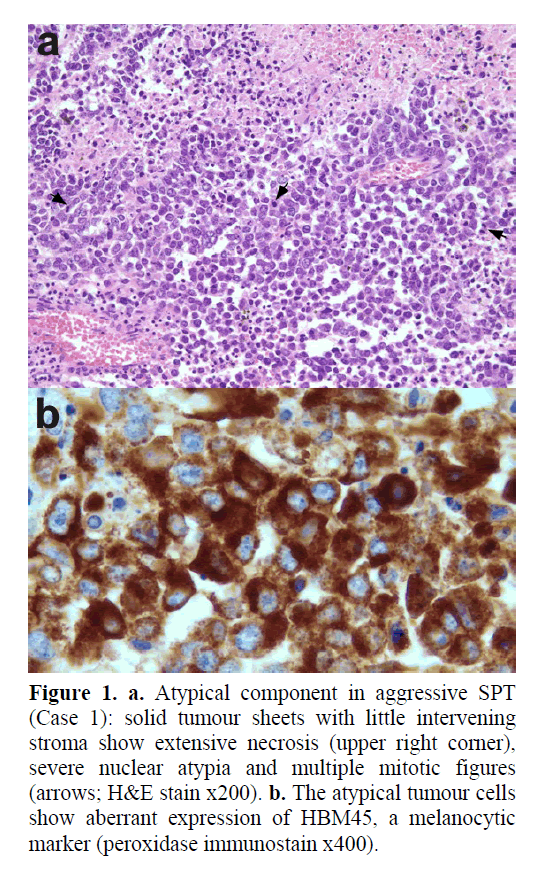 pancreas-atypical-component-aggressive