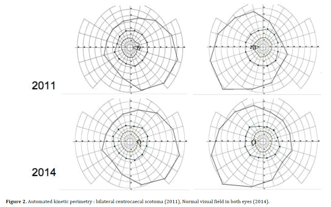 pancreas-automated-kinetic-perimetry