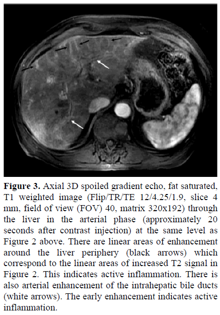 pancreas-axial-3d-gradient-inflammation