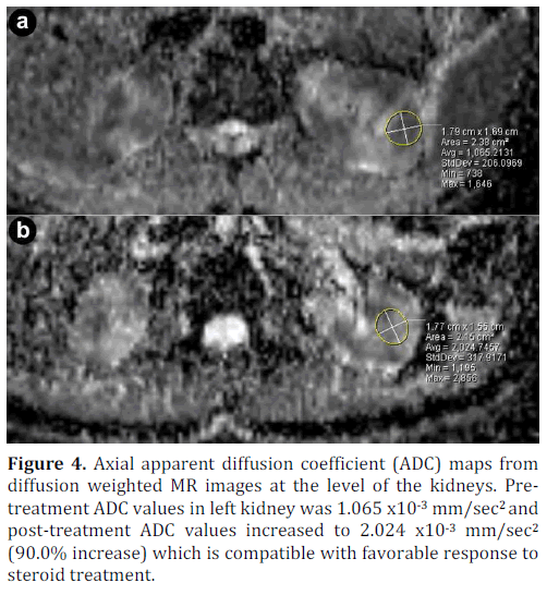 pancreas-axial-apparent-left-kidney