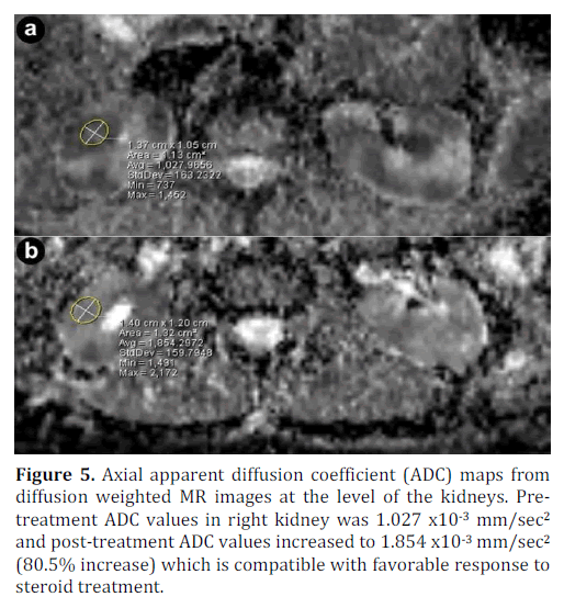 pancreas-axial-apparent-right-kidney