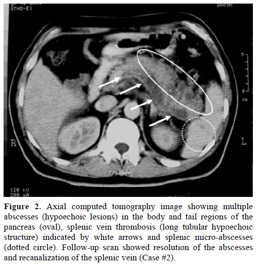 pancreas-axial-computed-hypoechoic-lesions