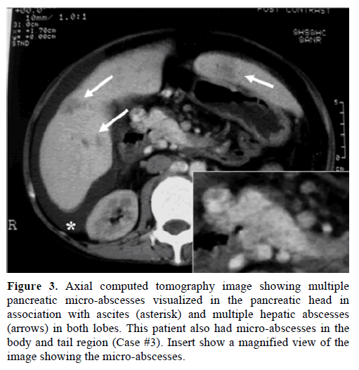 pancreas-axial-computed-micro-abscesses