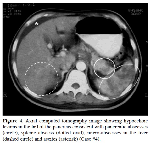 pancreas-axial-computed-pancreatic-abscesses