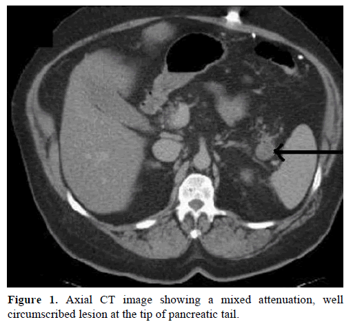 pancreas-axial-ct-image-mixed-attenuation