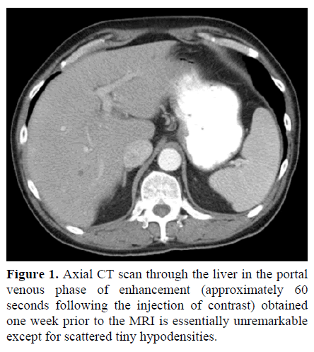 pancreas-axial-ct-scan-liver-portal