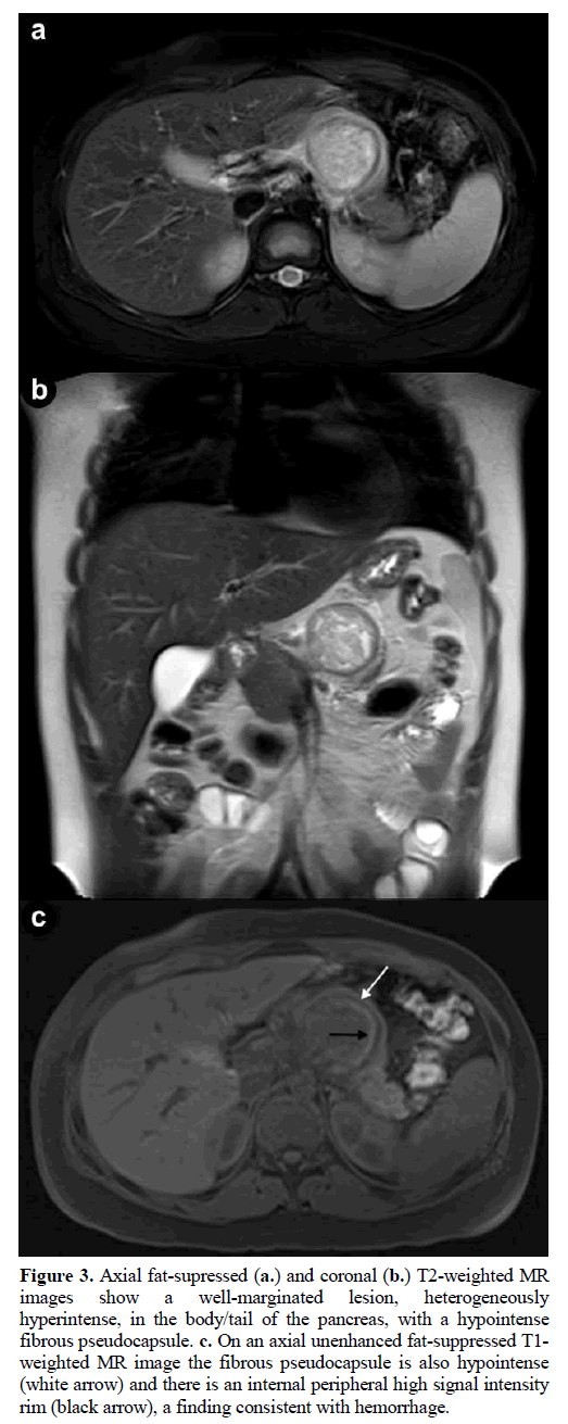 pancreas-axial-fat-supressed