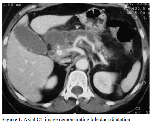 pancreas-axial-image-bile-duct-dilatation