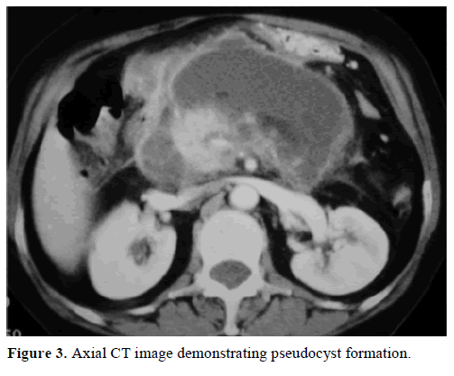 pancreas-axial-image-pseudocyst-formation