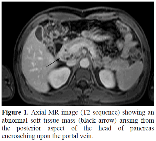 pancreas-axial-mr-image-abnormal-soft