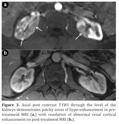 pancreas-axial-post-contrast-kidneys