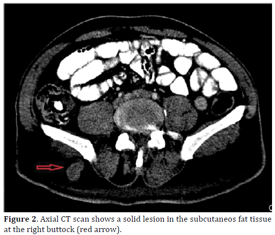 pancreas-axial-subcutaneos-buttock