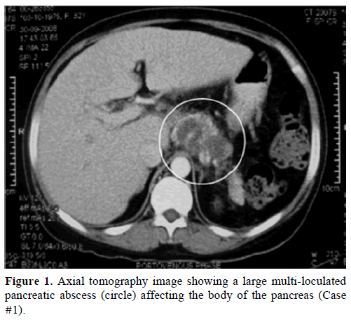 pancreas-axial-tomography-image-abscess
