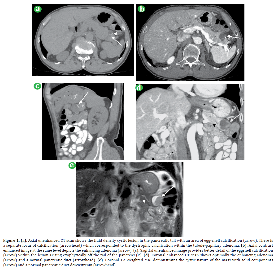 pancreas-axial-unenhanced-ct-scan