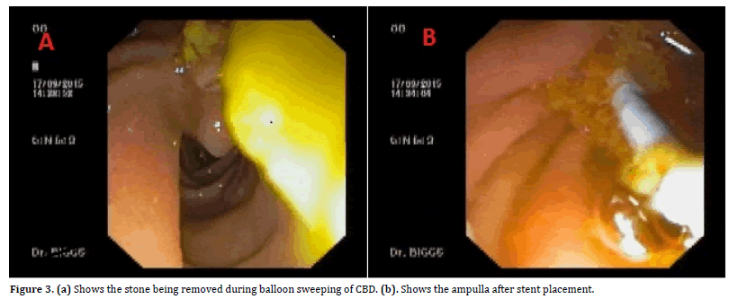 pancreas-balloon