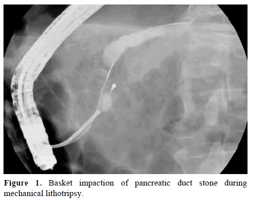 pancreas-basket-impaction-pancreatic-duct