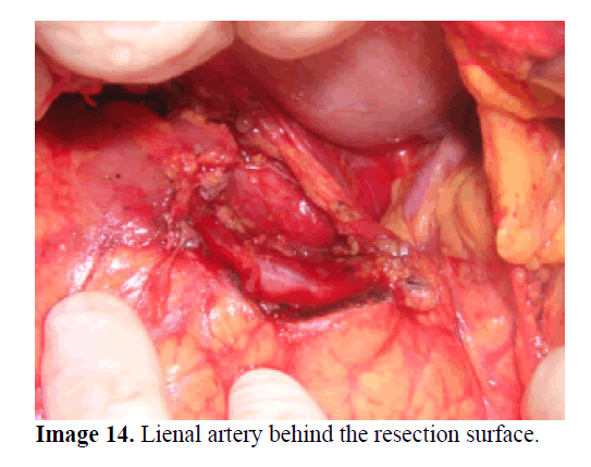 pancreas-behind-resection-surface