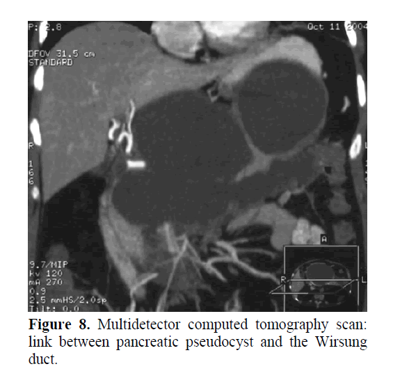 pancreas-between-pancreatic-pseudocyst