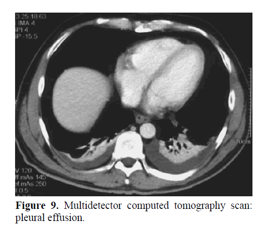 pancreas-between-pancreatic-pseudocyst