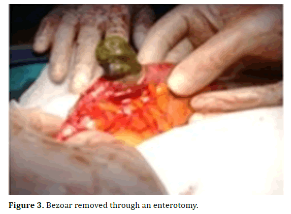 pancreas-bezoar-enterotomy