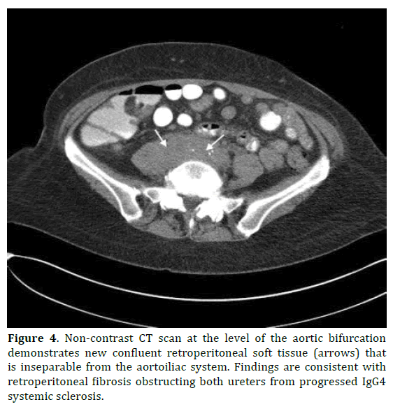 pancreas-bifurcation